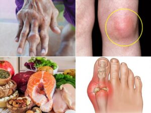 यूरिक एसिड को नेचुरल तरीके से कंट्रोल करने के घरेलू उपाय